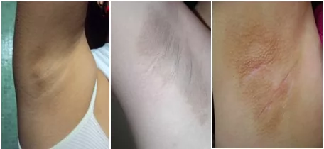 Manchas escuras nas axilas e virilhas: Como clarear?