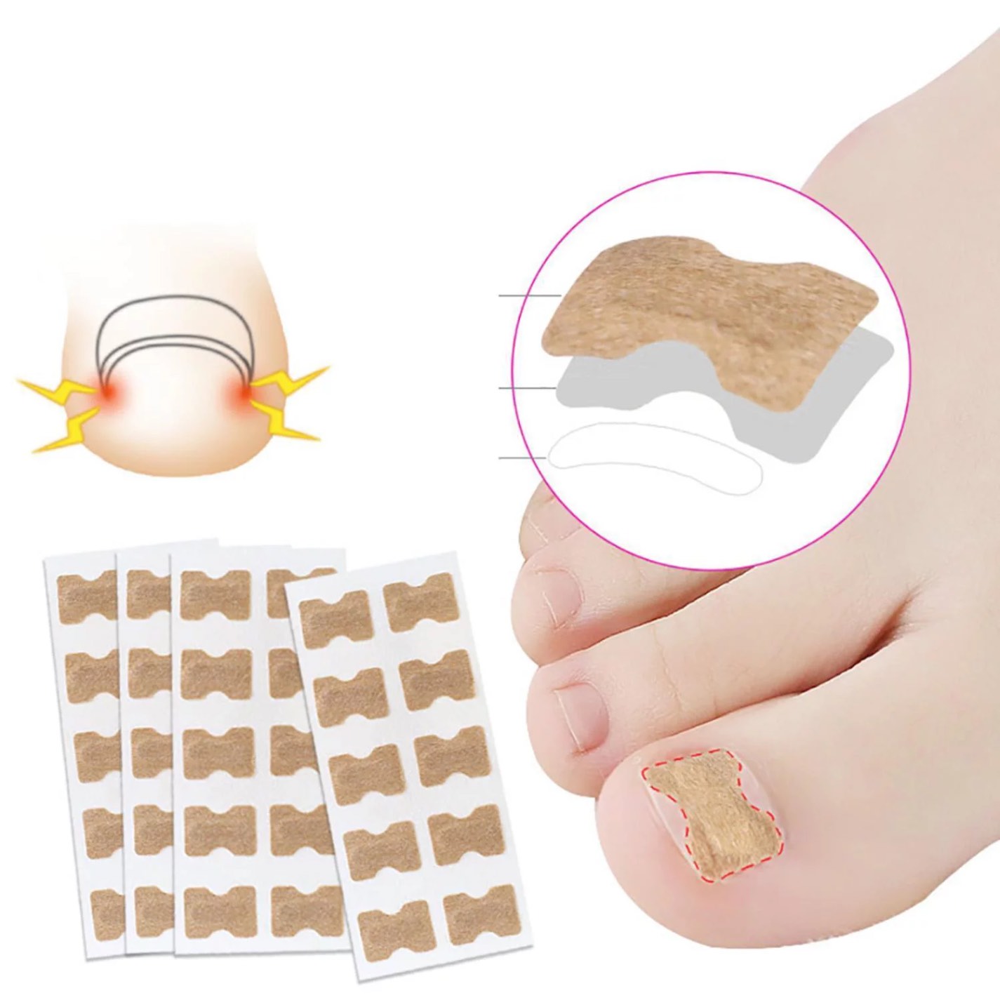 10 pcs Correção Toe Nail Strip Adesivo Anti-roll Nail Toe Inlay Unhas Órteses | Walmart Canadá